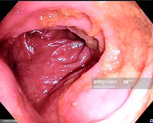 colonoscopy.jpg