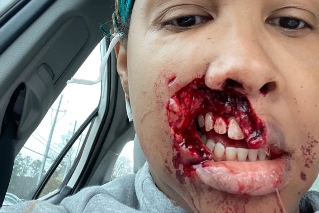 pitbullattackvictim.png